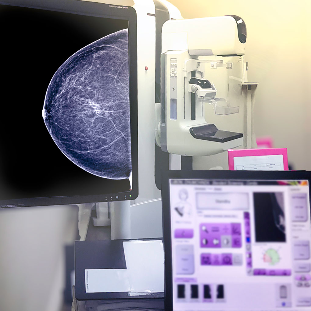 Mammogram sample