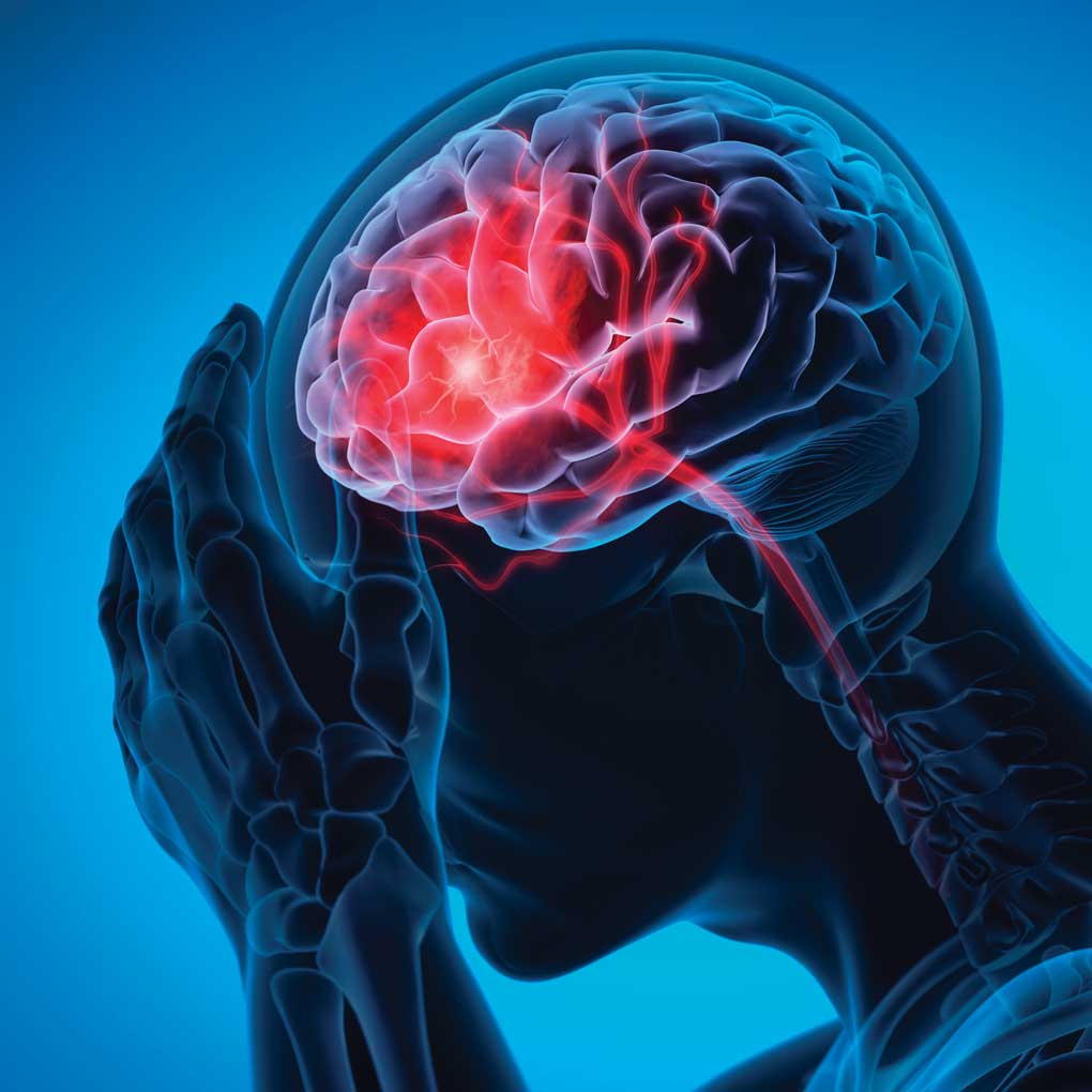 Stroke Brain Render