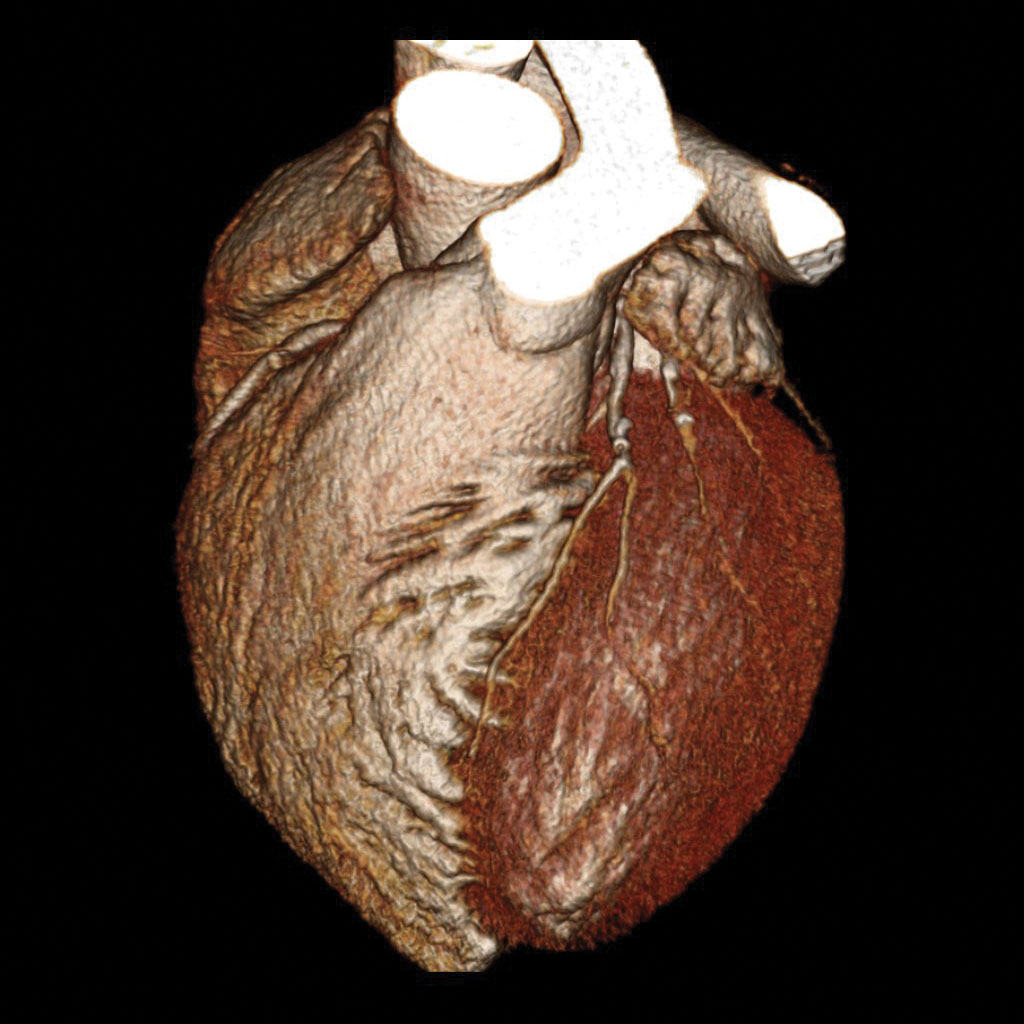 Heart CT for Coronary Calcium Score