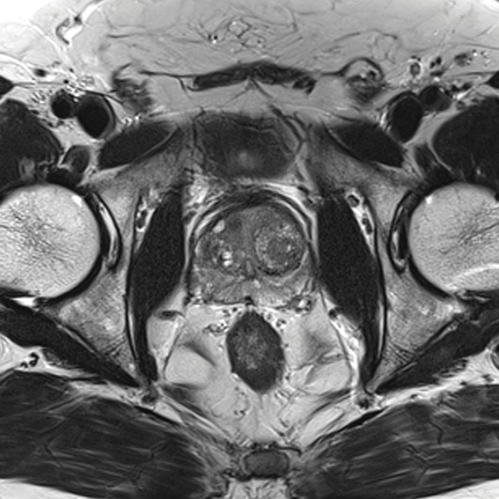 Prostate MRI Scan