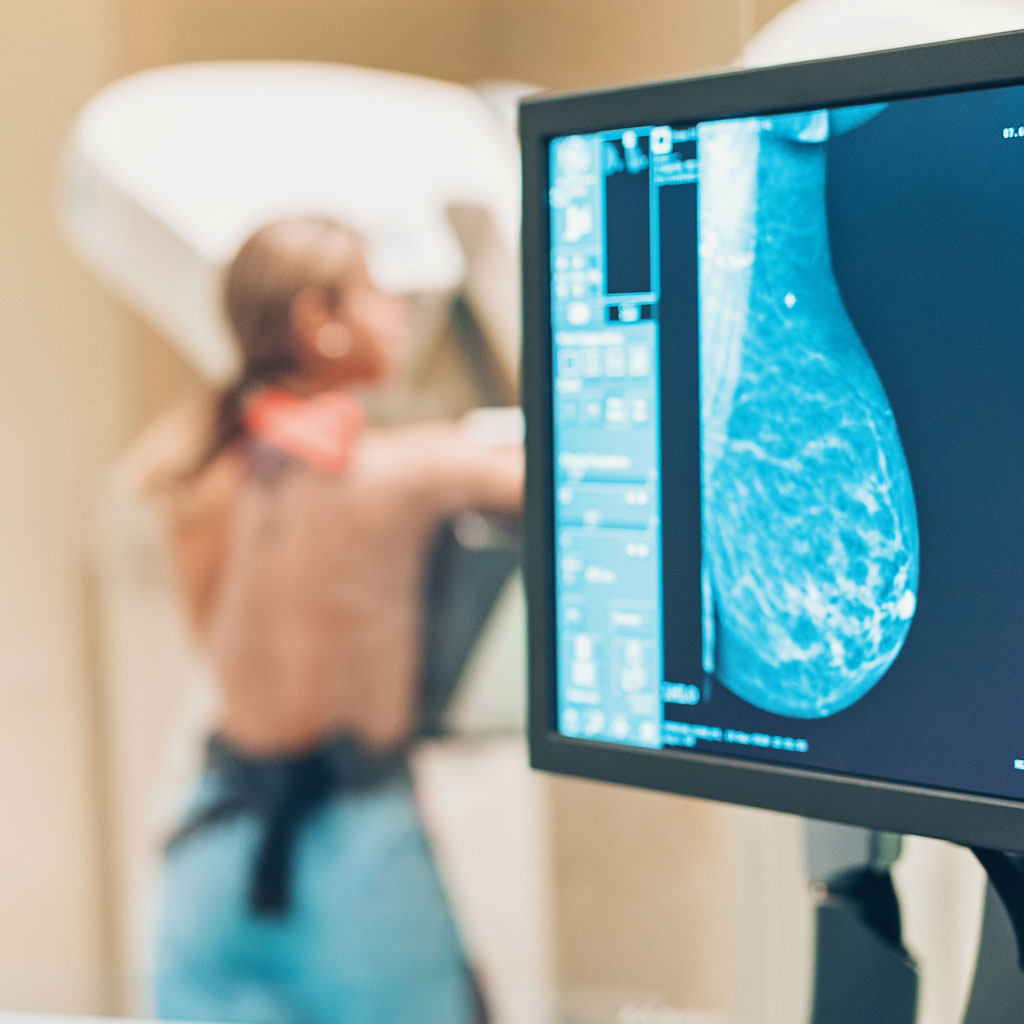 Mammograms and Breast Density